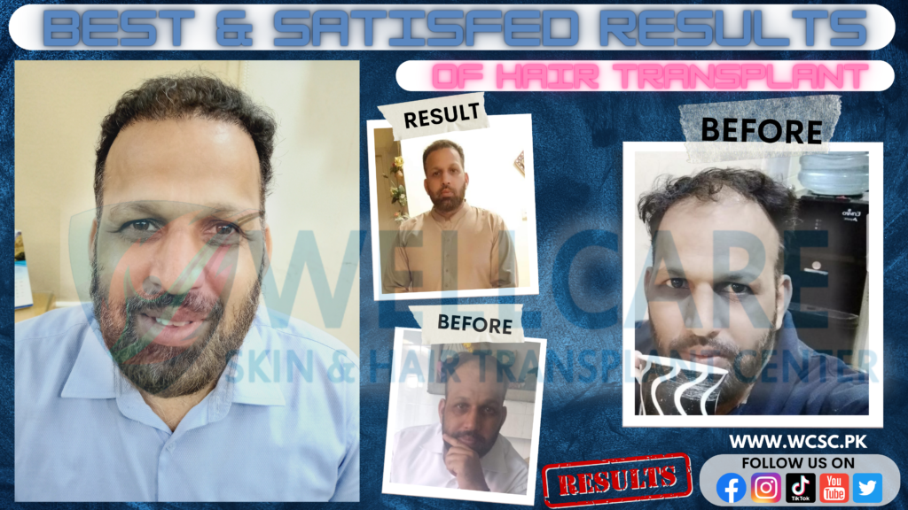 Before and after result at Wellcare