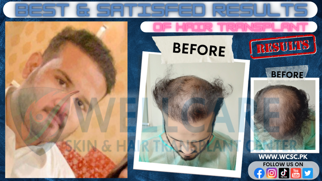 Before and after result at Wellcare