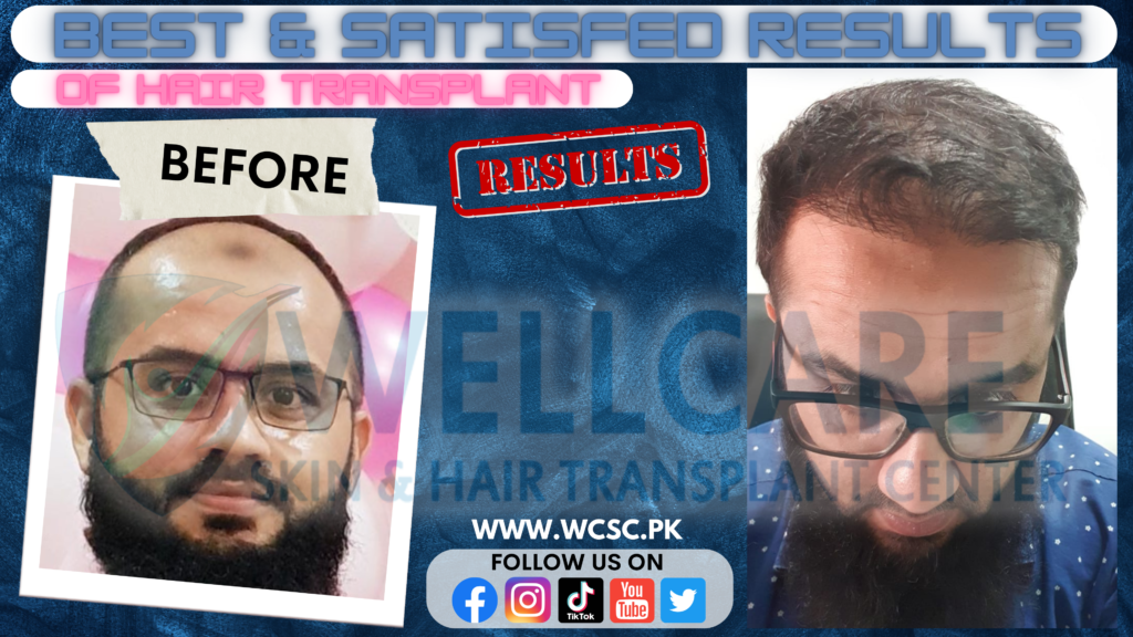 Before and after result at Wellcare