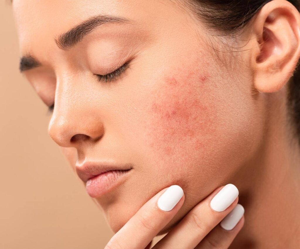 Acne Scar Subcision Treatment Acne Scar Subcision Treatment