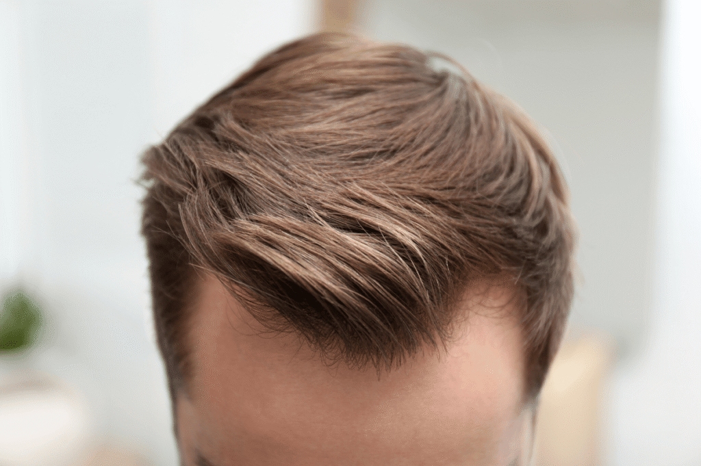 Hair Transplant vs Hair Duplication: Which One's for You?
