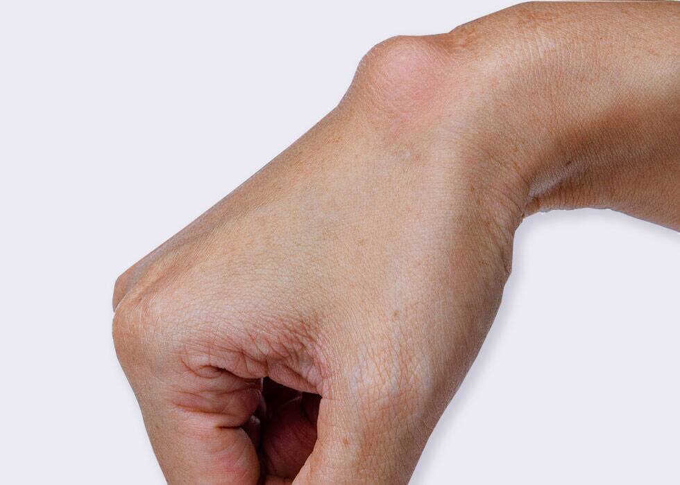 Cyst Removal Treatment