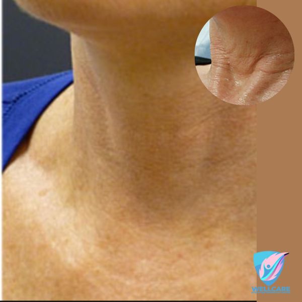 Body PRP Therapy