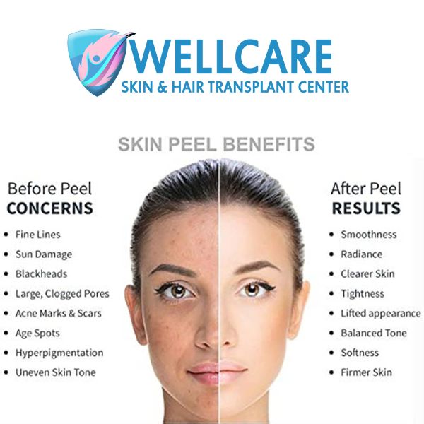 Peel Treatments